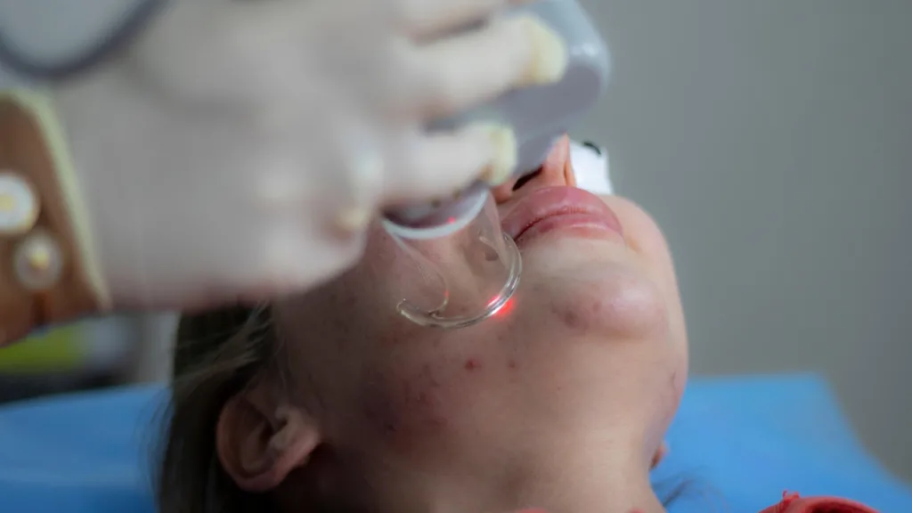 Dermatologista tratando acnes com laser