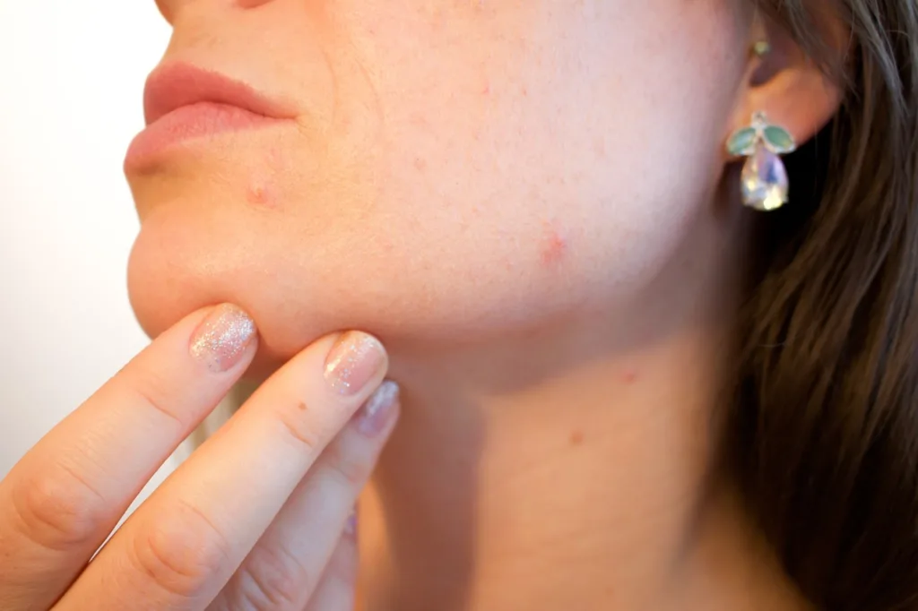 close do rosto de uma jovem se auto analisando  a procura de acne.