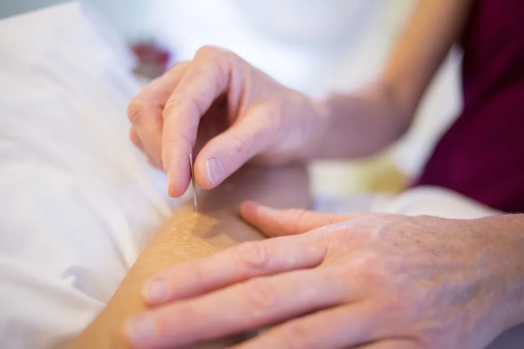imagem de uma mãos aplicando agulhas de acupuntura em um braço.
